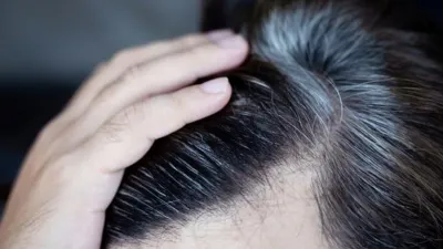 Repigmentasi Rambut Lebih Mungkin pada Uban Awal